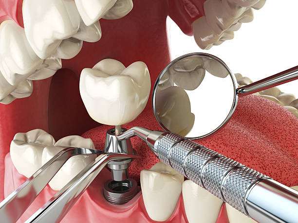 Best Emergency Dentist for Knocked-Out Tooth in Speedway, IN